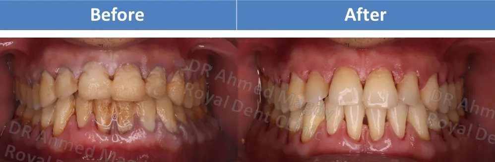 تنظيف الجير من الاسنان اكتوبر