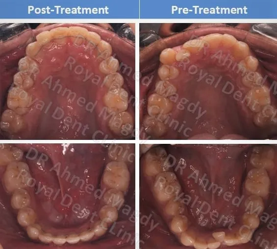 تقويم الاسنان قبل وبعد - عضة معكوسة -